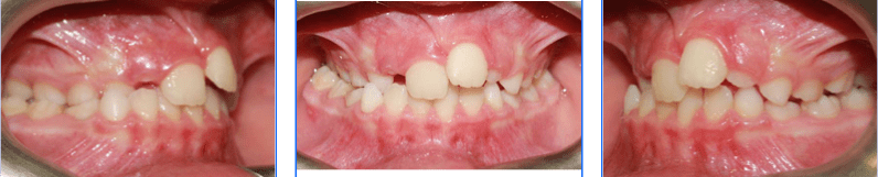 ortodoncia 7 años
